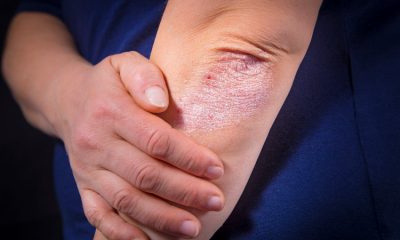 La psoriasis es una enfermedad inflamatoria crónica que se manifiesta principalmente con lesiones inflamadas en la piel. Foto: Gentileza.