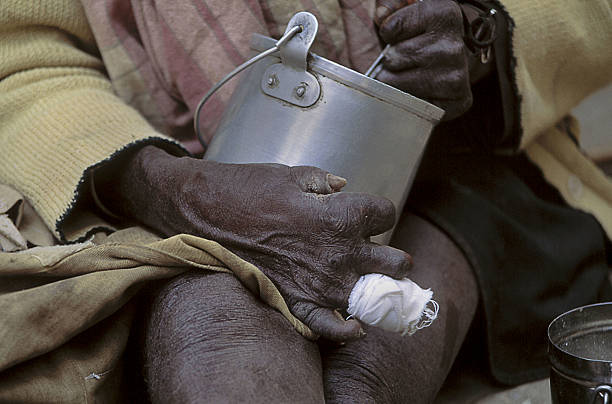 En 2019, 24 países de América reportaron casos nuevos de lepra, con un total de 35.231 casos. Foto: Getty Images.