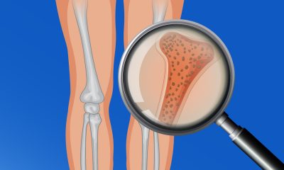 Osteoporosis. Foto referencial.