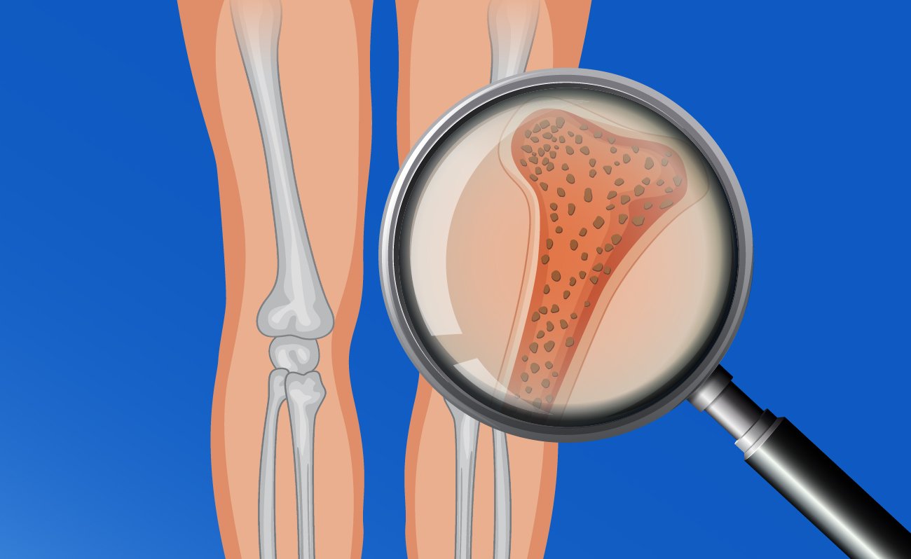 Osteoporosis. Foto referencial.