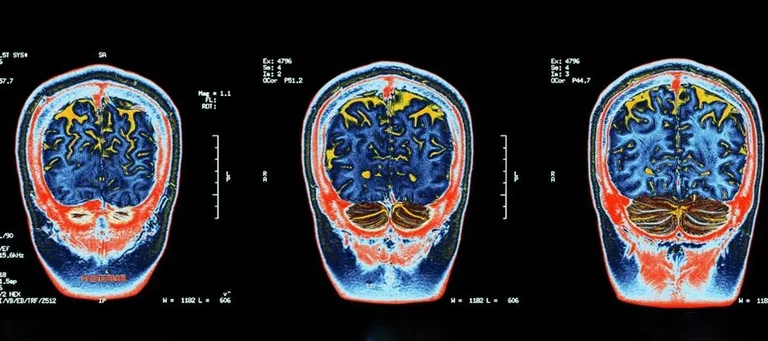 Las personas socialmente aisladas tenían una cognición más pobre, incluida la memoria y el tiempo de reacción, y un menor volumen de materia gris en muchas partes del cerebro. Foto: Infobae