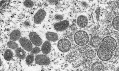 Partículas maduras del virus de la viruela del mono. Foto: Infobae.