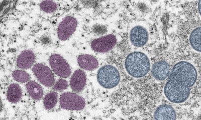 Imagen de microscopía electrónica de una partícula de la viruela del mono. Foto: El País.