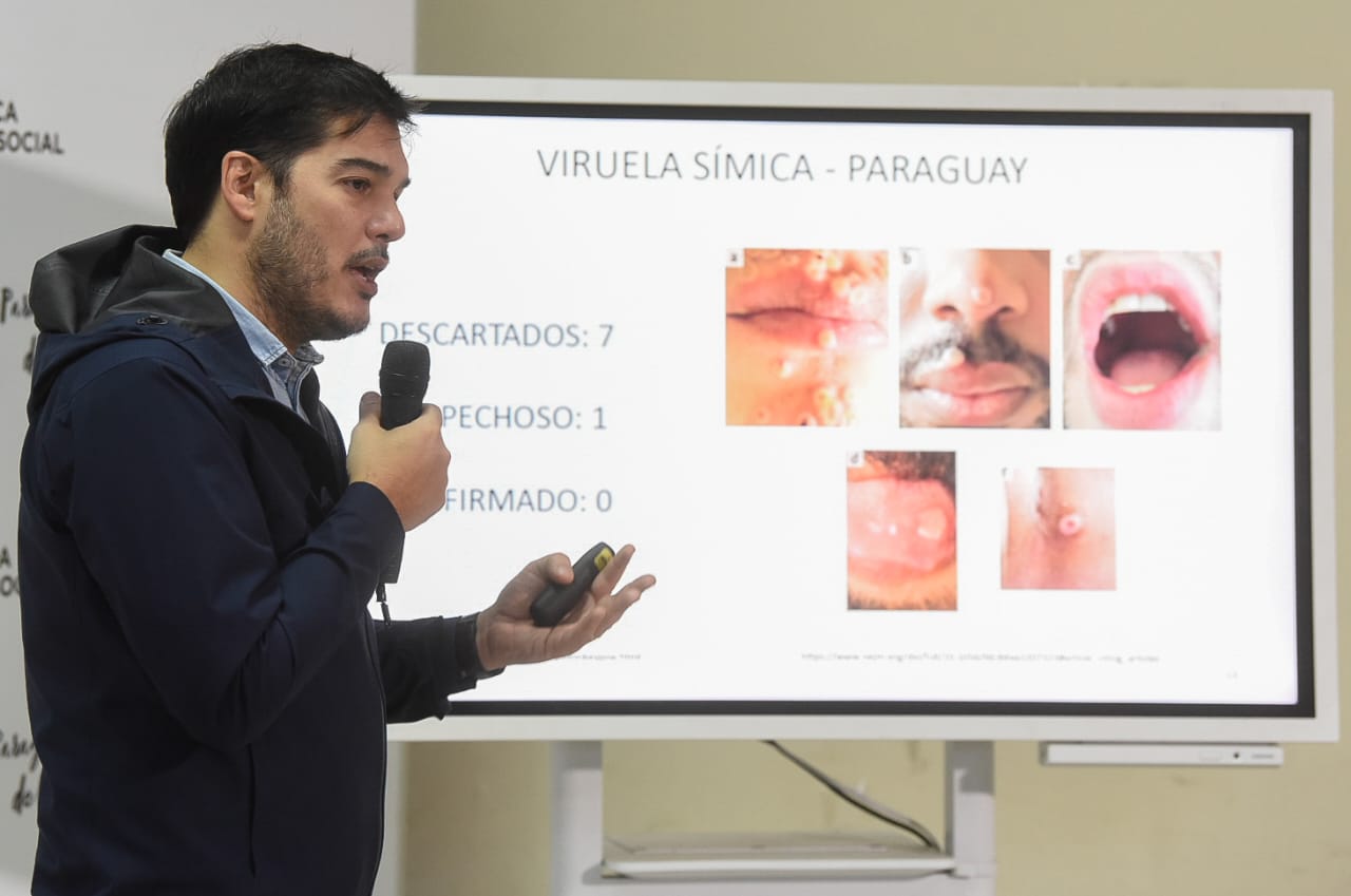 Guillermo Sequera, sobre viruela del mono. Foto: Salud