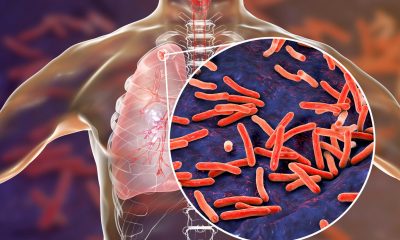 Imagen ilustrativa de cómo las bacterias atacan a los pulmones.