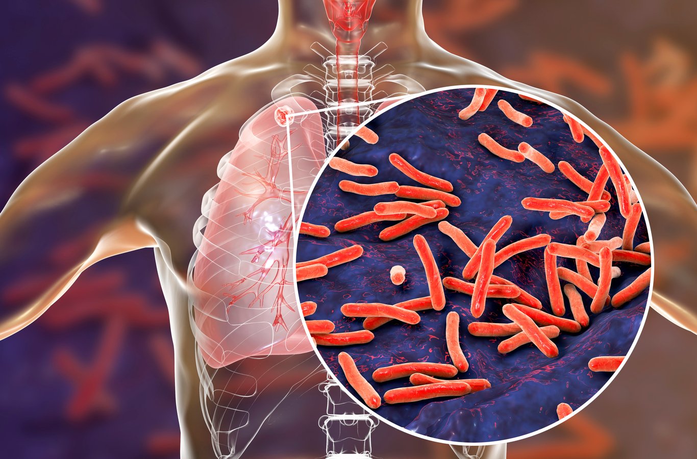 Imagen ilustrativa de cómo las bacterias atacan a los pulmones.