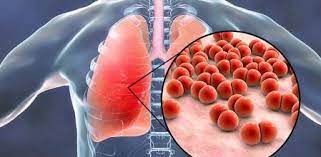 La neumonía afecta los pulmones por la presencia de virus y bacterias.