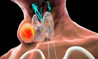 El tratamiento de tiroides varía y puede incluir control, medicamentos, cirugía o terapia de yodo radiactivo. Foto: BBC Mundo