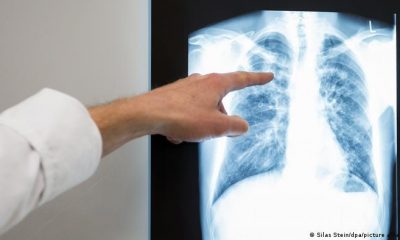 La tuberculosis también se peude diagnosticar mediante una radiografía de tórax. Foto: DW