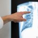 La tuberculosis también se peude diagnosticar mediante una radiografía de tórax. Foto: DW