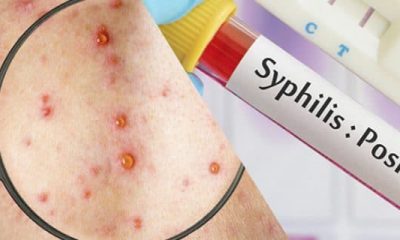 Sífilis. Imagen de referencia