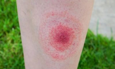 Rasgos de la enfermedad de Lyme, transmitida por garrapatas. Foto: Cuidateplus.