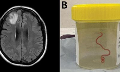 Un escáner cerebral y el nematodo extraído en un frasco de muestras. Foto: BBC.