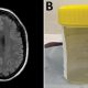 Un escáner cerebral y el nematodo extraído en un frasco de muestras. Foto: BBC.