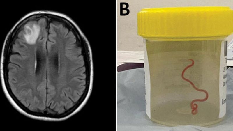 Un escáner cerebral y el nematodo extraído en un frasco de muestras. Foto: BBC.