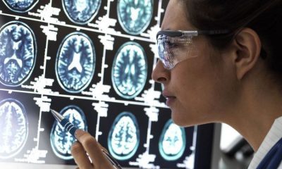 La enfermedad de Alzheimer se caracteriza por la pérdida de células cerebrales o neuronas. Foto: BBC.