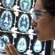 La enfermedad de Alzheimer se caracteriza por la pérdida de células cerebrales o neuronas. Foto: BBC.