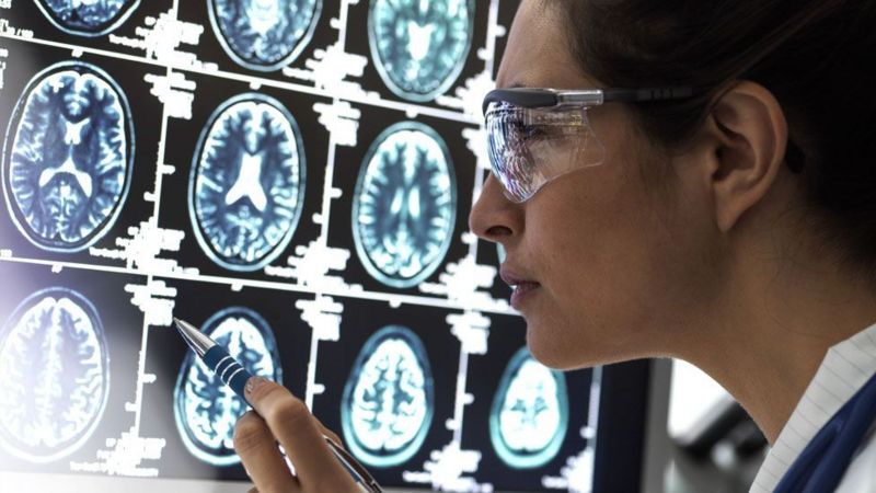 La enfermedad de Alzheimer se caracteriza por la pérdida de células cerebrales o neuronas. Foto: BBC.