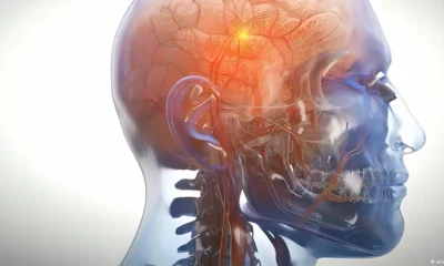 Las estimaciones mundiales en 2019 mostraban que más de 8,5 millones de personas padecían Parkinson, según datos de la OMS. Foto: DW.