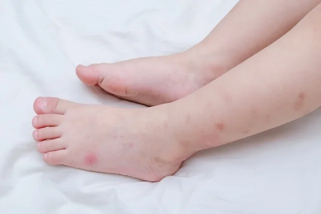 Niño con Dengue. Foto referencial. Tua Saude.