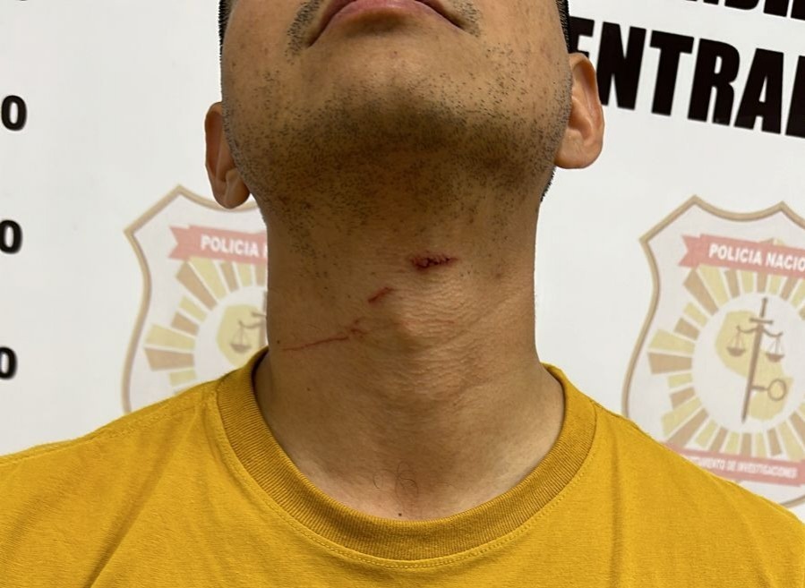 El hombre mostró las lesiones. Foto: Policía Nacional.