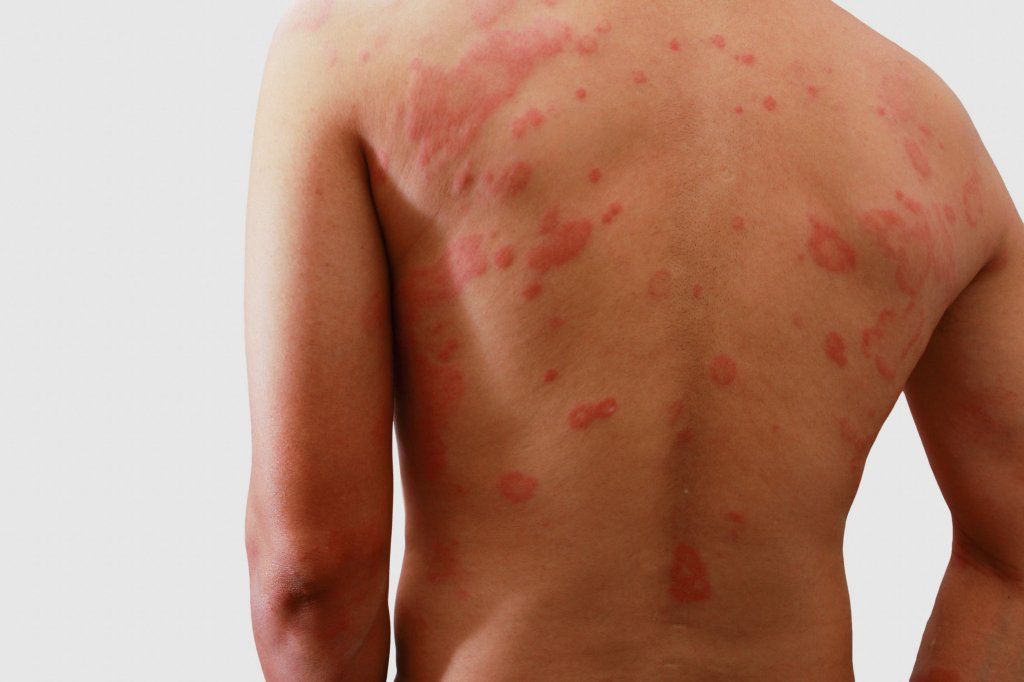 Dermatitis. Foto: Clínica San Martin.