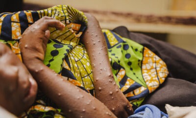 Un paciente joven recibe atención por mpox en la unidad de aislamiento y tratamiento del hospital Lwiro, apoyado por UNICEF, en la República Democrática del Congo (© UNICEF/UNI639933/Mirindi Johnson).