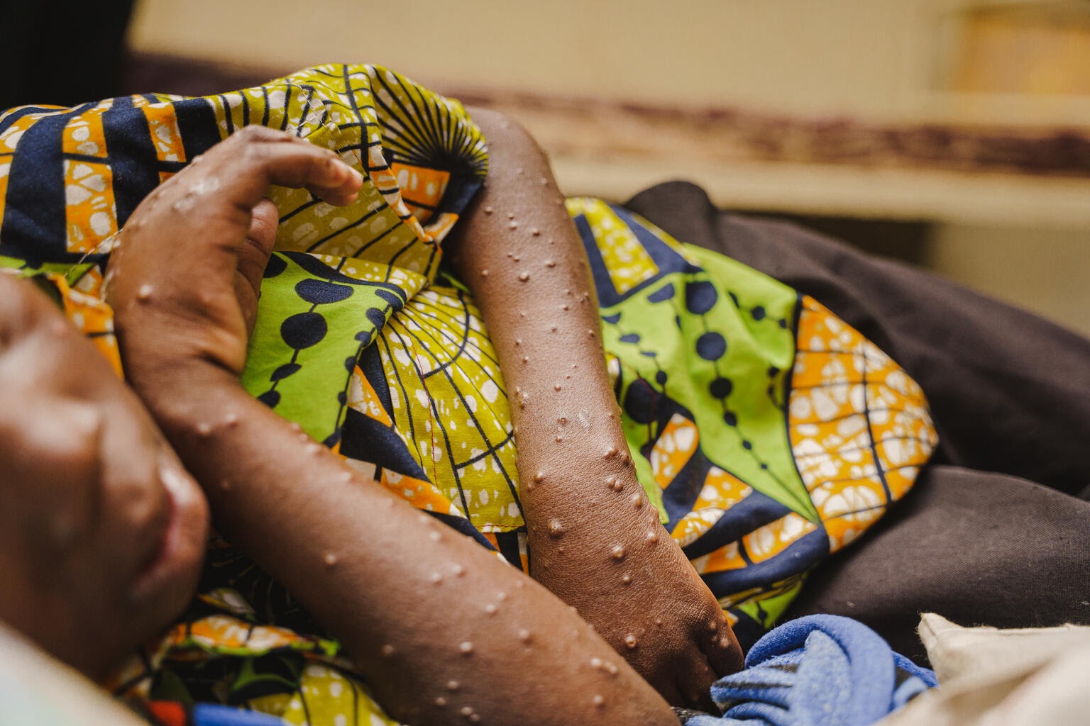 Un paciente joven recibe atención por mpox en la unidad de aislamiento y tratamiento del hospital Lwiro, apoyado por UNICEF, en la República Democrática del Congo (© UNICEF/UNI639933/Mirindi Johnson).