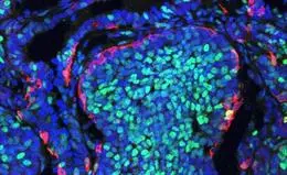 Imagen de un tumor de mama en ratón que muestra la segregación de ambas poblaciones celulares - IN-CSIC-UMH - Archivo