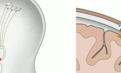 Representación gráfica del prototipo de implante cerebral de Neuralink. Imagen: La Nacion/IMAGO