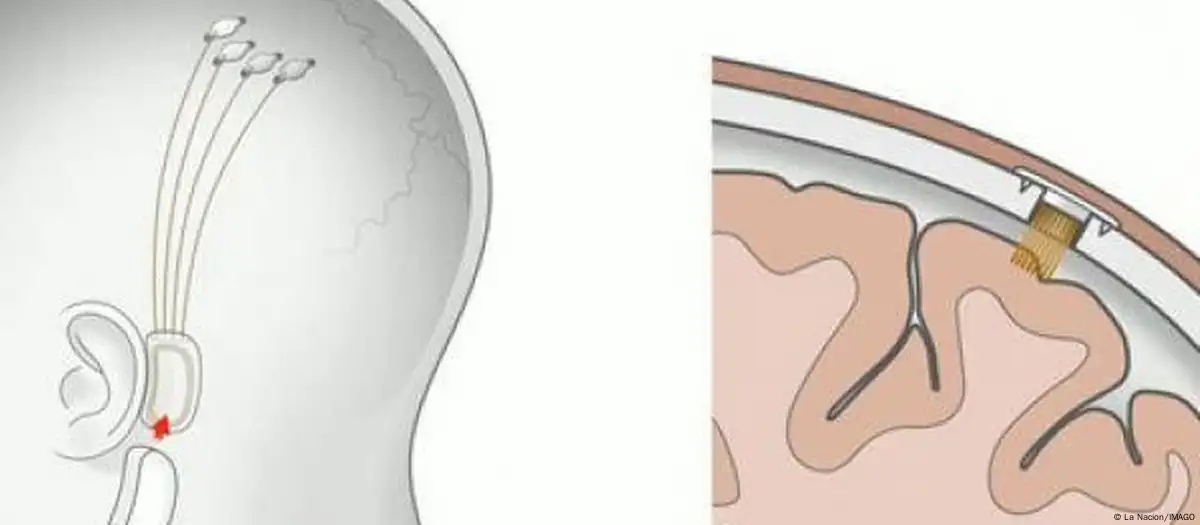 Representación gráfica del prototipo de implante cerebral de Neuralink. Imagen: La Nacion/IMAGO