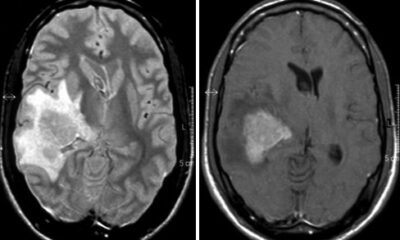 Linfoma cerebral - HOSPITAL RUBER INTERNACIONAL