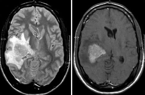 Linfoma cerebral - HOSPITAL RUBER INTERNACIONAL